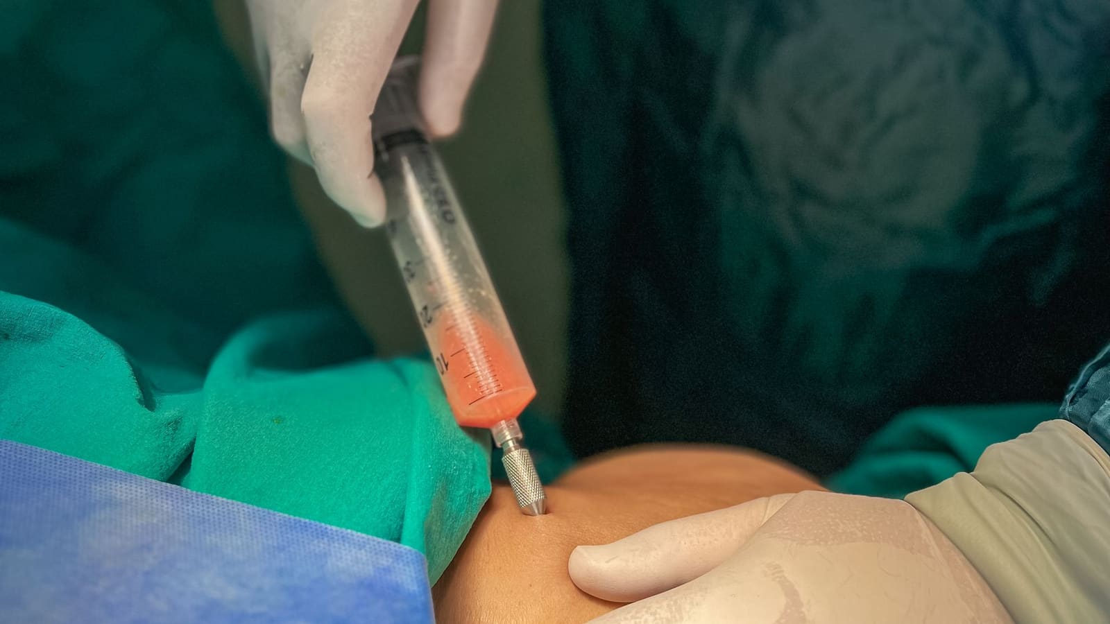 A gloved pain specialist performs an injection procedure through a sterile drape, guiding the needle by hand.